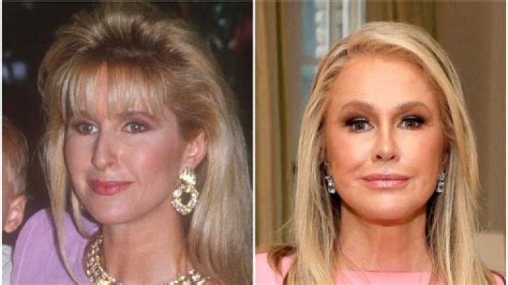 Kathy Hilton Nose Job A Promise Of Transformation